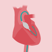 cutaway of heart, with transfemoral TAVI valve being implanted