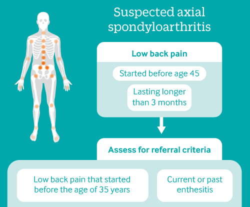 Spondyloarthritis: diagnosis and management: summary of NICE guidance ...